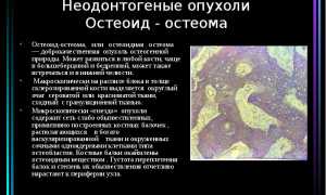 Рентгенологические признаки остеомы
