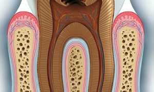 Халатность и безразличие приведут к потере зубов! Глубокий кариес: симптомы и последствия