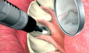 Внутриканальное отбеливание зубов