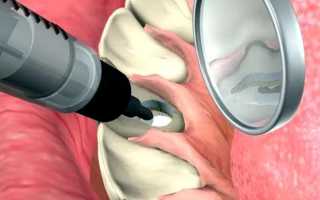 Внутриканальное отбеливание зубов