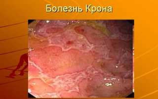 Опухоли толстого кишечника и лечение