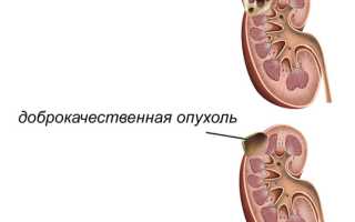 Стадии и симптомы рака почки
