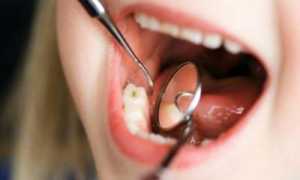 Ребенок также подвержен развитию патологий полости рта! Лечение кариеса у детей