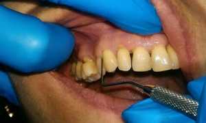 Что является самым эффективным способом лечения периодонтита?