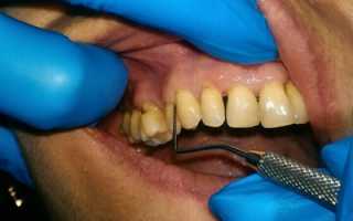 Что является самым эффективным способом лечения периодонтита?