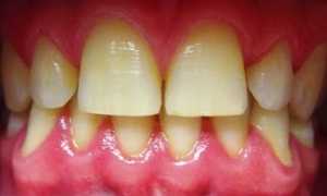 Симптомы, характерные для пародонтита