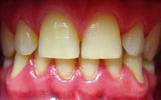 Симптомы, характерные для пародонтита