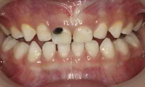 Вот почему кариес у детей – причина для немедленного похода к стоматологу