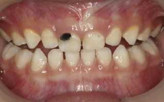 Вот почему кариес у детей – причина для немедленного похода к стоматологу