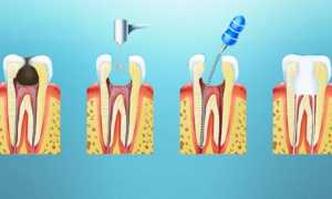 Лечение пульпита без удаления нерва: стадии и особенности