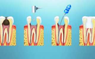 Лечение пульпита без удаления нерва: стадии и особенности