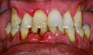 Гранулированный периодонтит