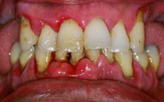 Гранулированный периодонтит