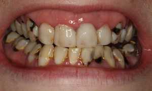 Какими методами можно вылечить кариес?