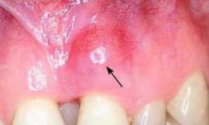 Осложнения