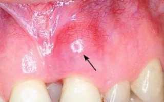 Осложнения