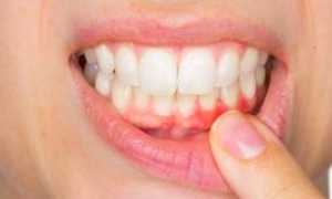 Воспалились десны? Самые эффективные антибиотики при пародонтозе