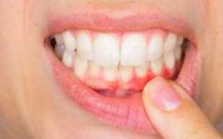 Воспалились десны? Самые эффективные антибиотики при пародонтозе