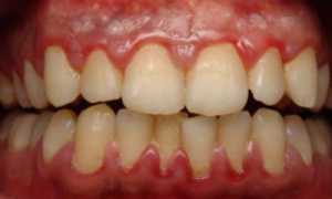 Зуд, кровоточивость и другие неприятные симптомы! Гингивит: что это такое