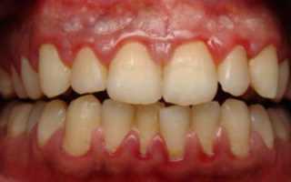 Зуд, кровоточивость и другие неприятные симптомы! Гингивит: что это такое