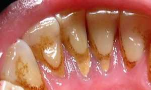 Как мазь от пародонтоза спасает зубы? Советы стоматологов