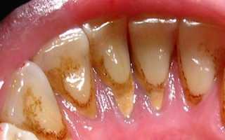 Как мазь от пародонтоза спасает зубы? Советы стоматологов