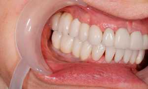 Вернут ли прекрасную улыбку импланты зубов?