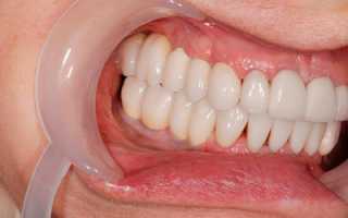 Вернут ли прекрасную улыбку импланты зубов?