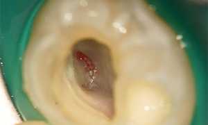 Причины возникновения пульпита