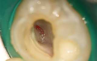 Причины возникновения пульпита