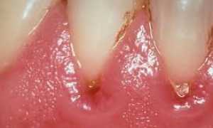 Признаки пародонтоза в зависимости от его типа и стадии