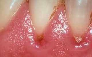 Признаки пародонтоза в зависимости от его типа и стадии