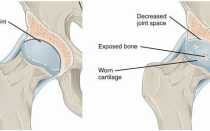 Суставная щель коленного сустава