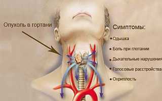 Рак гортани: симптомы и история болезни