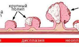 Симпотомы опухоли 12-пёрстной кишки