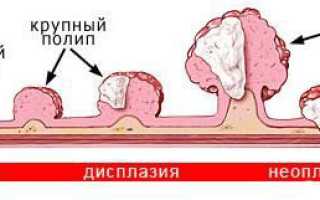 Симпотомы опухоли 12-пёрстной кишки