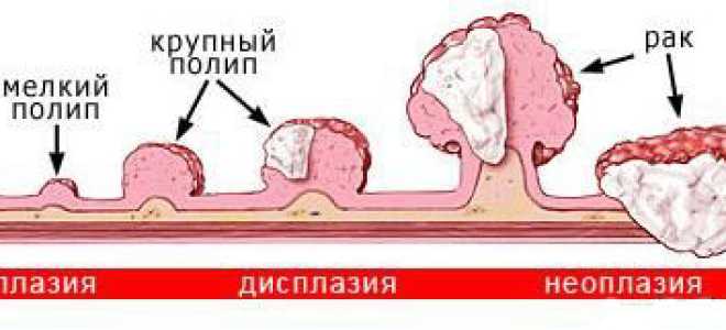 Симпотомы опухоли 12-пёрстной кишки