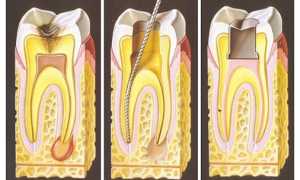Гангренозный пульпит: формы, их особенности, диагностика и лечение
