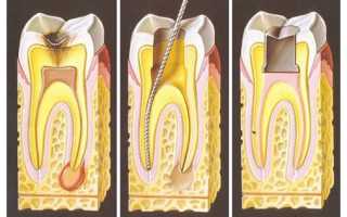 Гангренозный пульпит: формы, их особенности, диагностика и лечение