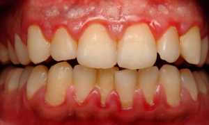 Многоликая болезнь: формы и виды гингивита, классификации симптомов и способы лечения