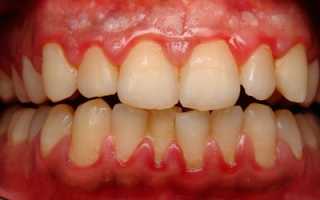 Многоликая болезнь: формы и виды гингивита, классификации симптомов и способы лечения