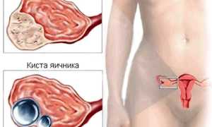 Симптомы и лечение опухолей яичников у женщин