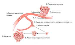 Что такое метастазы?