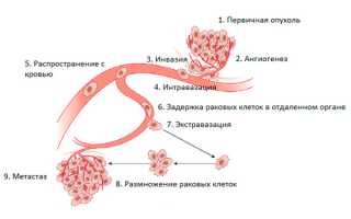 Что такое метастазы?