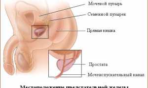 Чем лечить аденому простаты у мужчин?