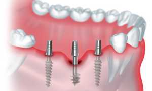 Что нужно знать про эту процедуру? Особенности базальной имплантации зубов