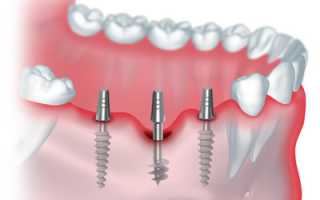 Что нужно знать про эту процедуру? Особенности базальной имплантации зубов
