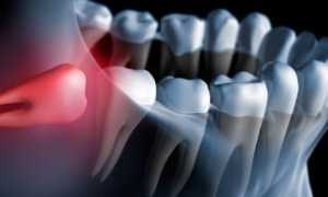 Есть ли спасение от муки: какое обезболивающее поможет, когда болит зуб мудрости?