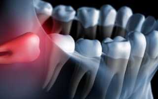Есть ли спасение от муки: какое обезболивающее поможет, когда болит зуб мудрости?