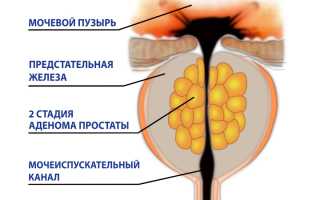 Остаточная моча при аденоме предстательной железы